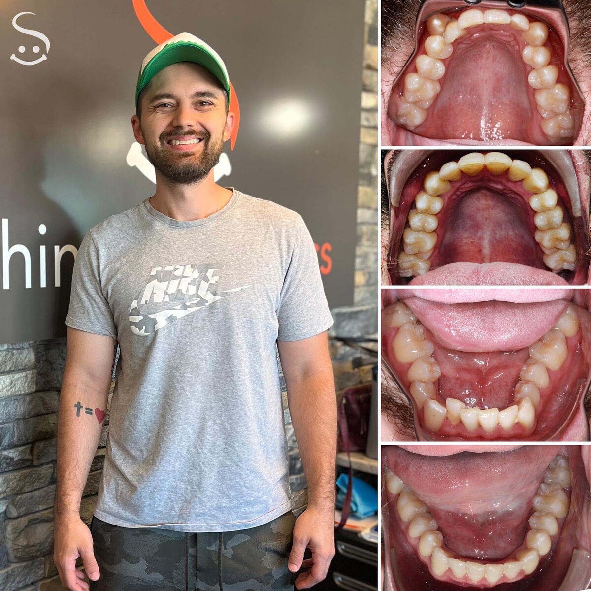 Man smiling with collage of teeth pictures